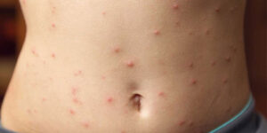 ALLERGY & SKIN DISEASE